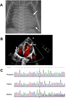 Case Report: A Chinese child with Barth syndrome caused by a novel TAFAZZIN mutation